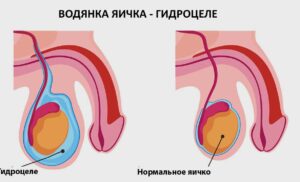 гидроцеле