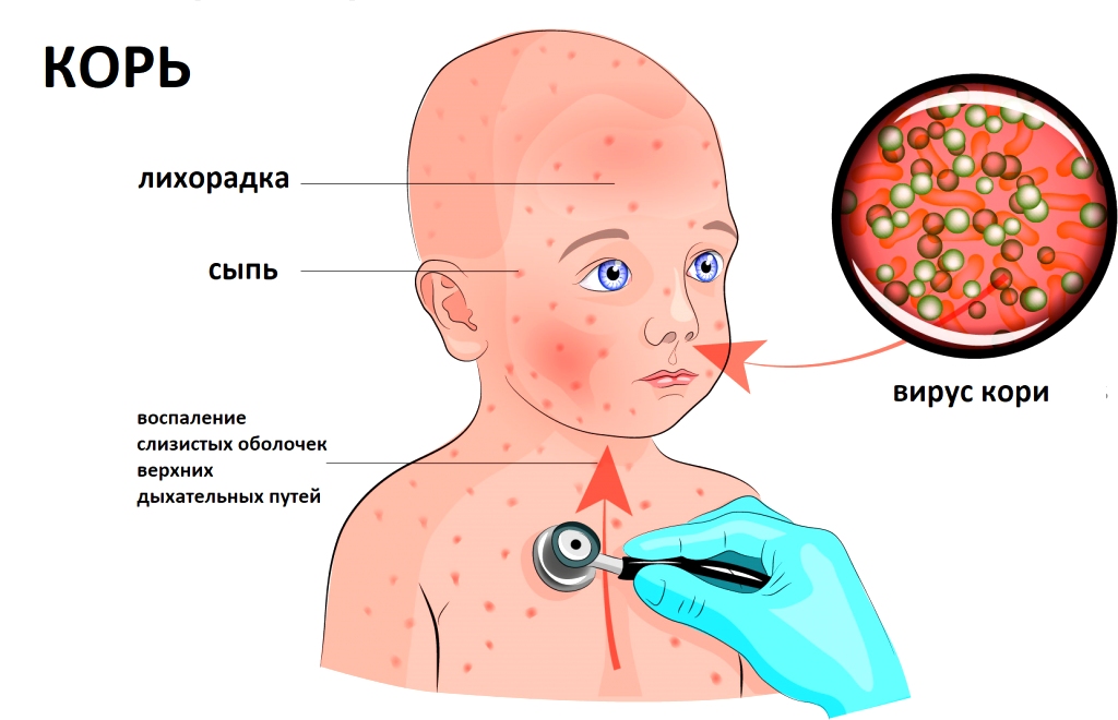 Заболевания вируса кори