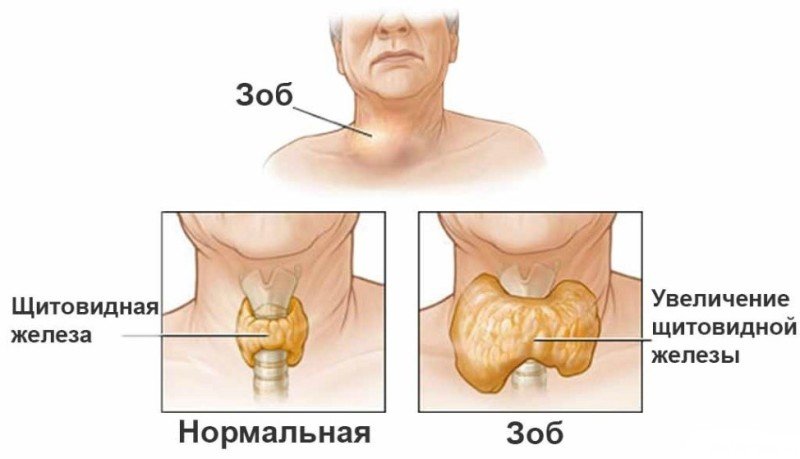 (Токсический зоб) Базедова Болезнь