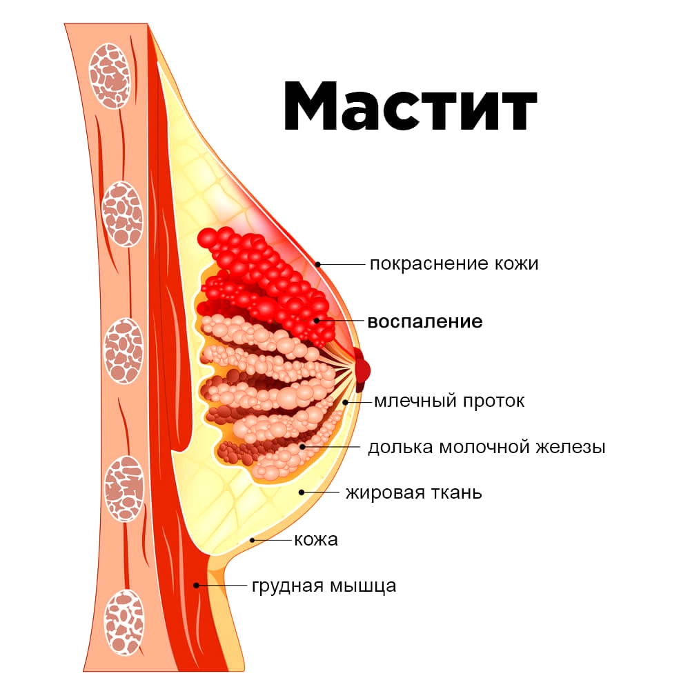 мастит