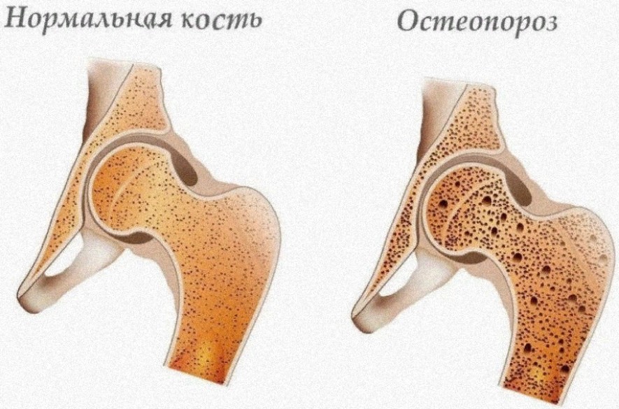 Сравнение нормальной кости и больной остеопорозом