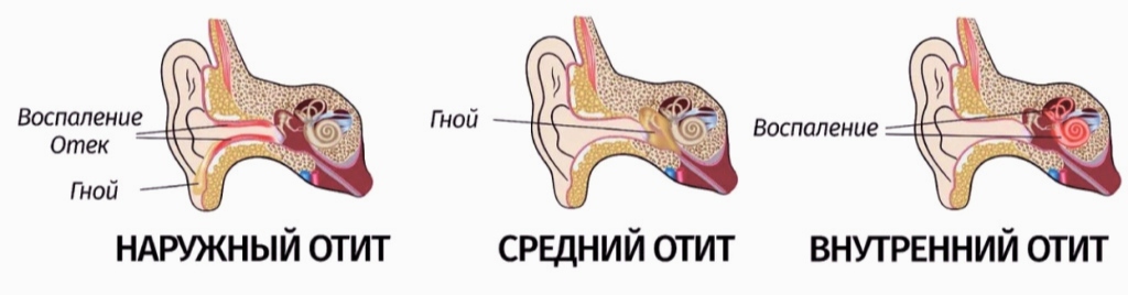 отит