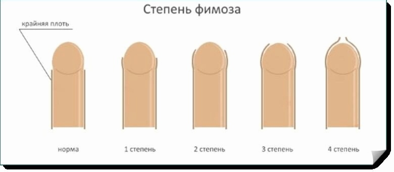 фимоз степени
