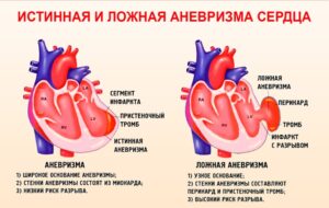 виды аневризмы сердца