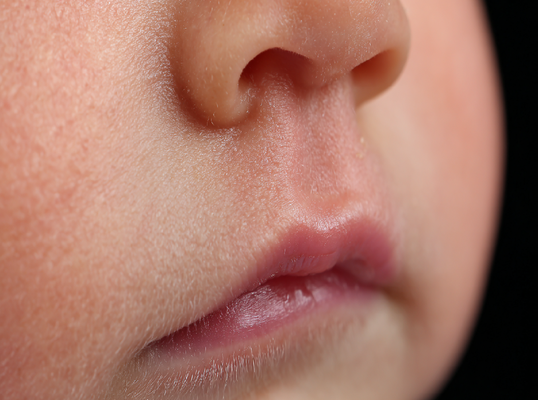 Заячья губа (расщелина губы)