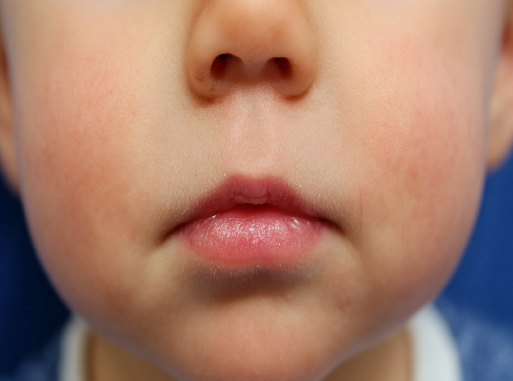 Заячья губа (расщелина губы)