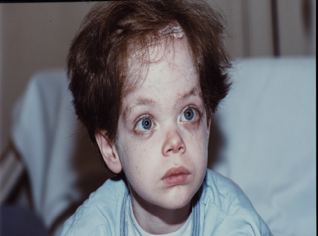 Синдром Иценко-Кушинга