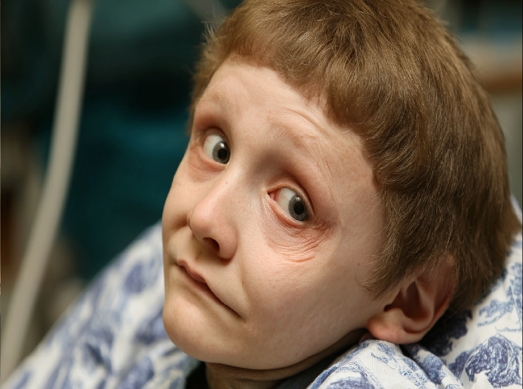 Синдром Иценко-Кушинга