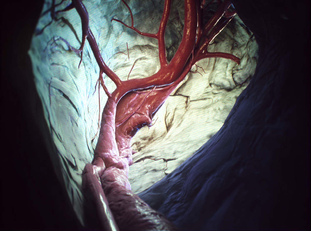 Аневризма аорты