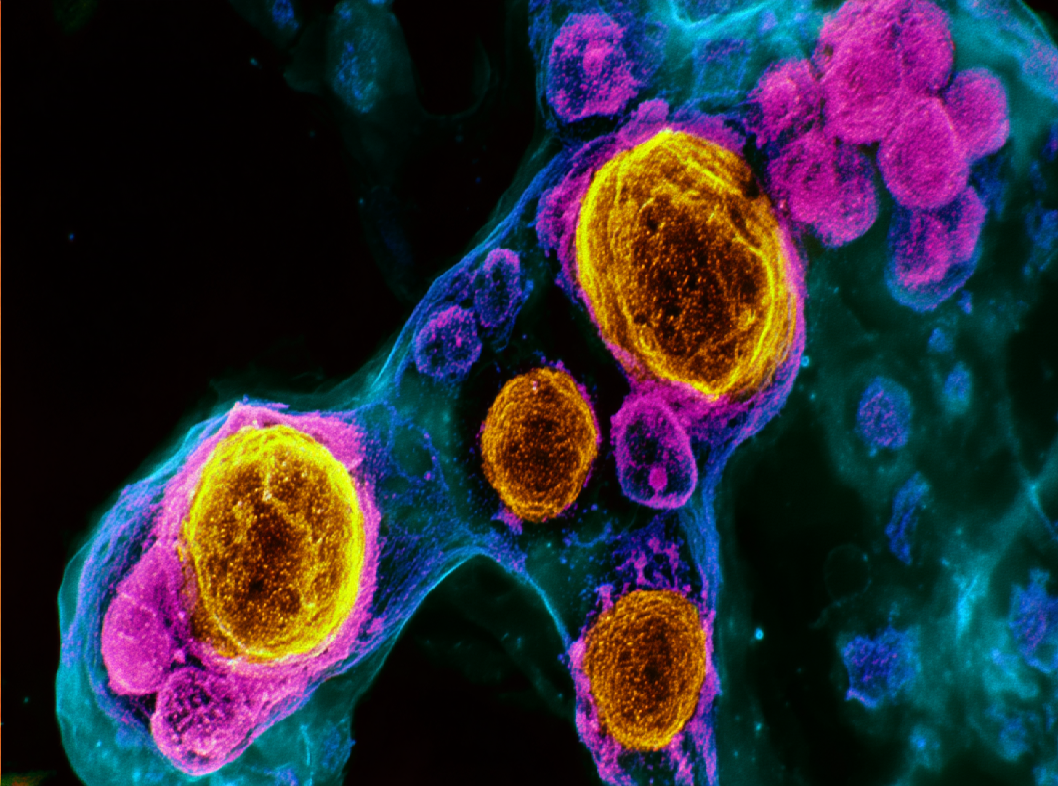 Онкомаркер СА-19.9