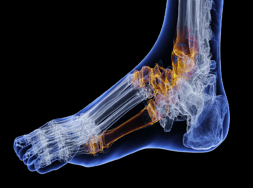 Остеомиелит