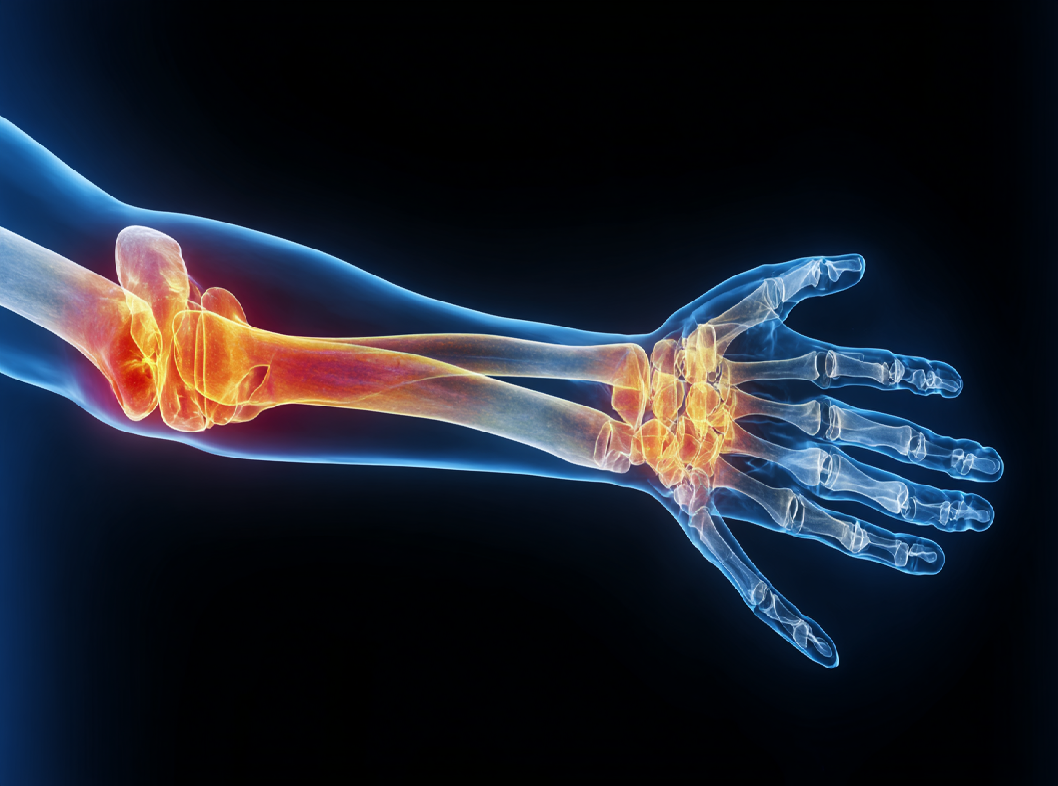 Остеомиелит