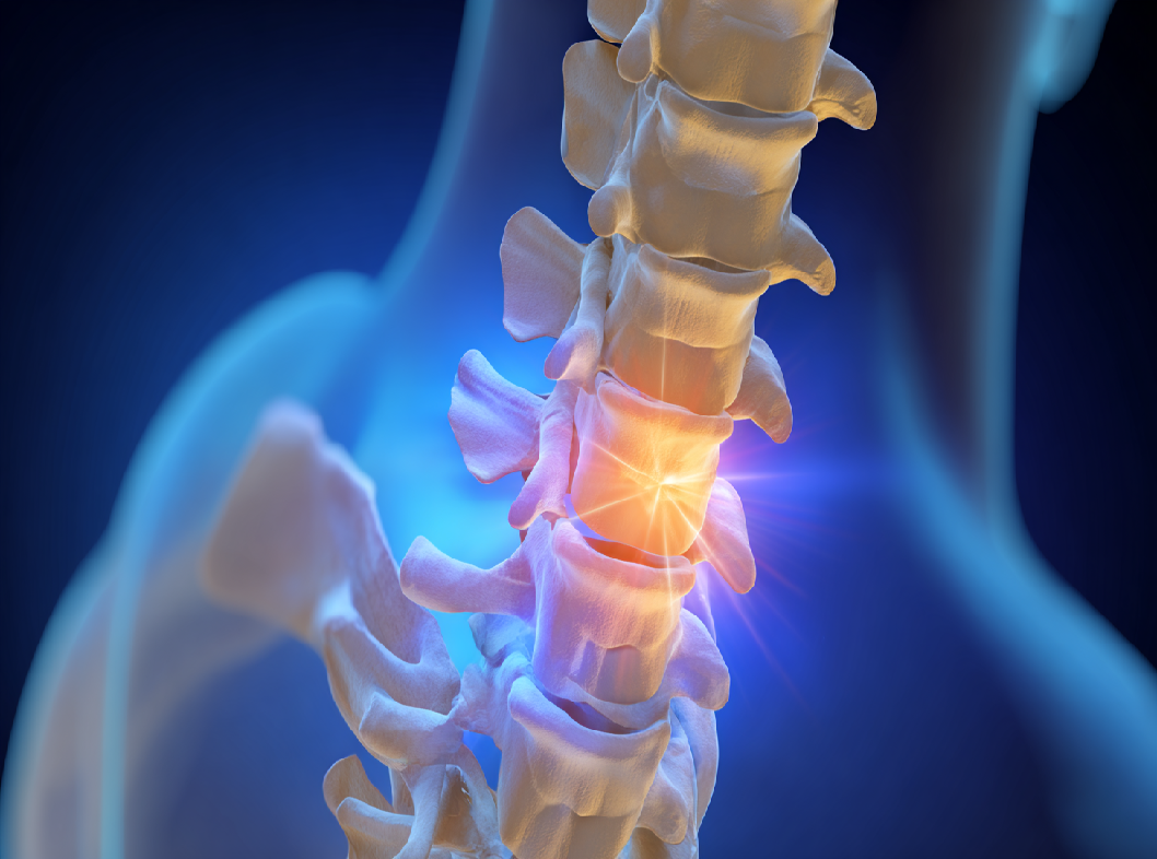 Грыжа межпозвонкового диска
