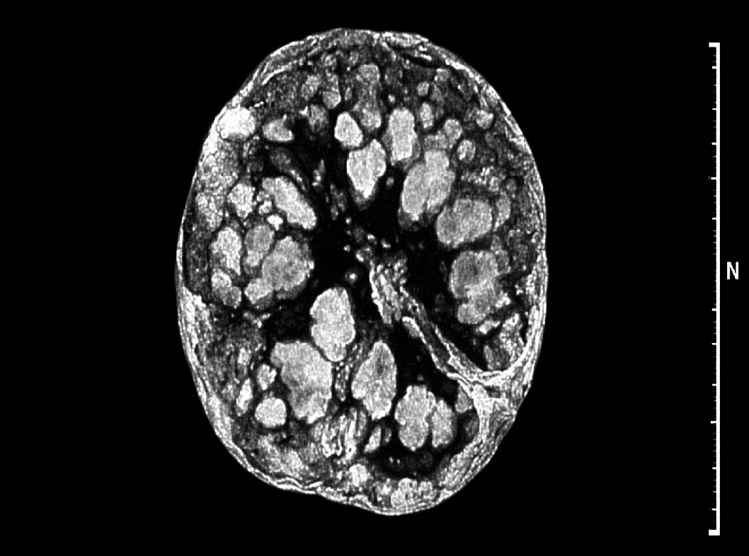 Пролактинома