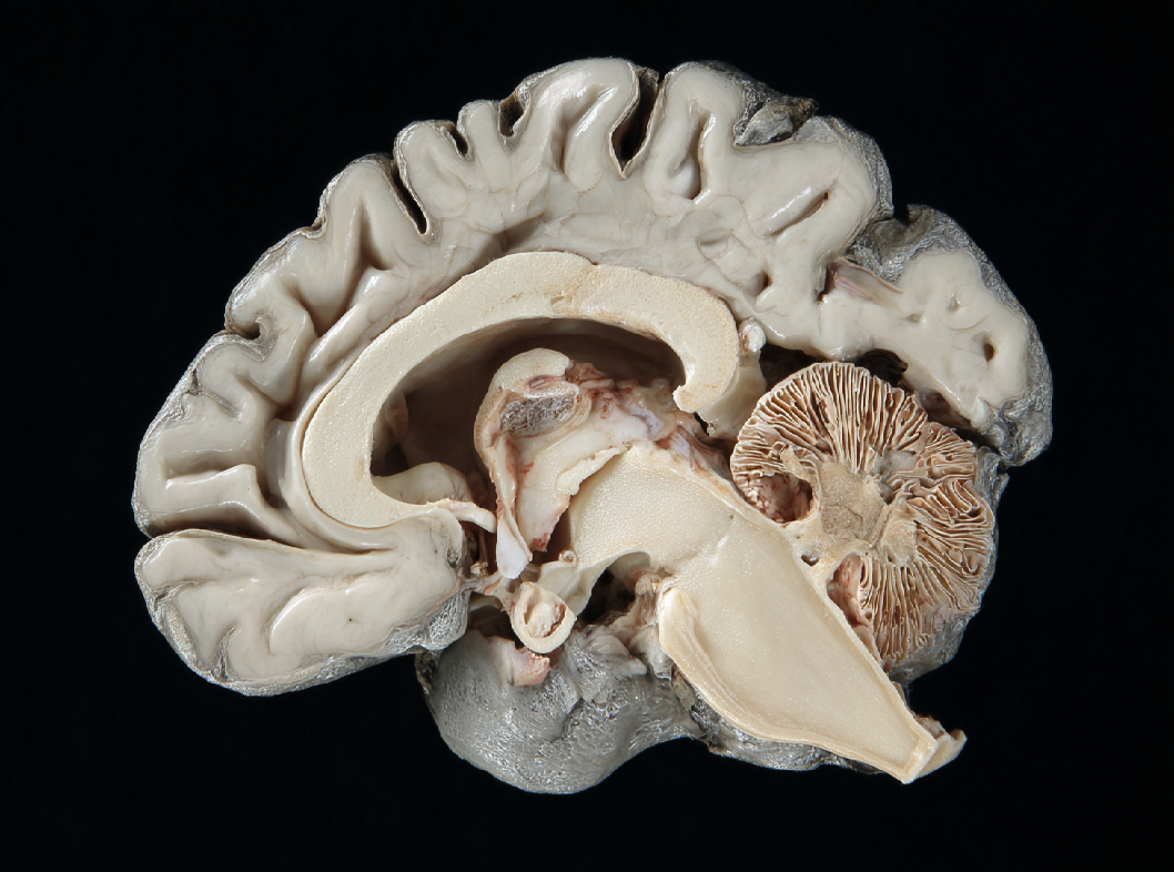 Пролактинома