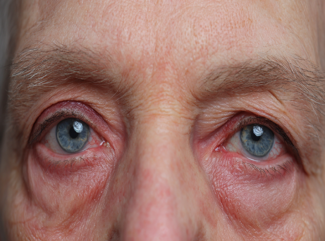 Синдром Горнера