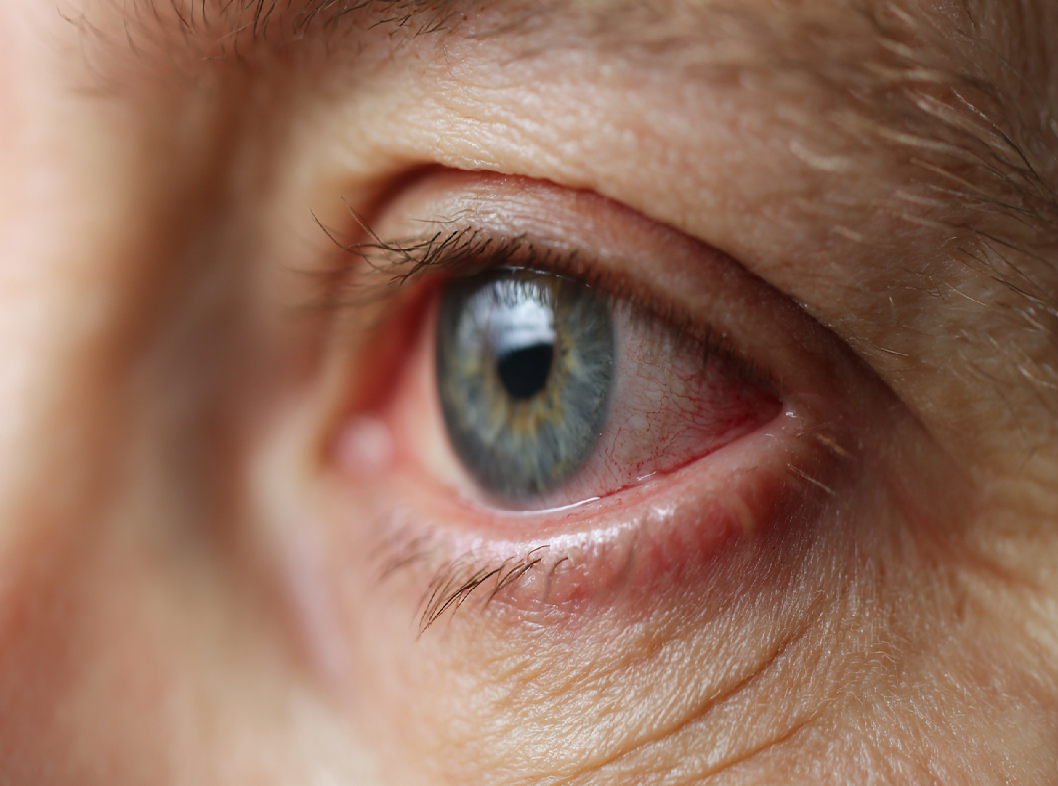 Синдром Горнера