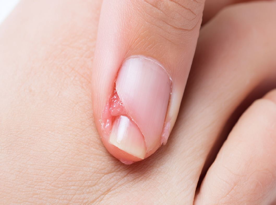 Вросший ноготь