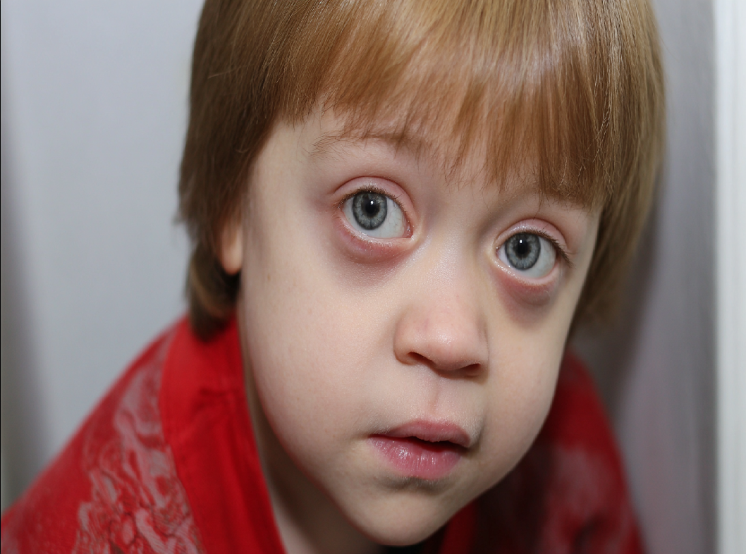 Адреногенитальный синдром