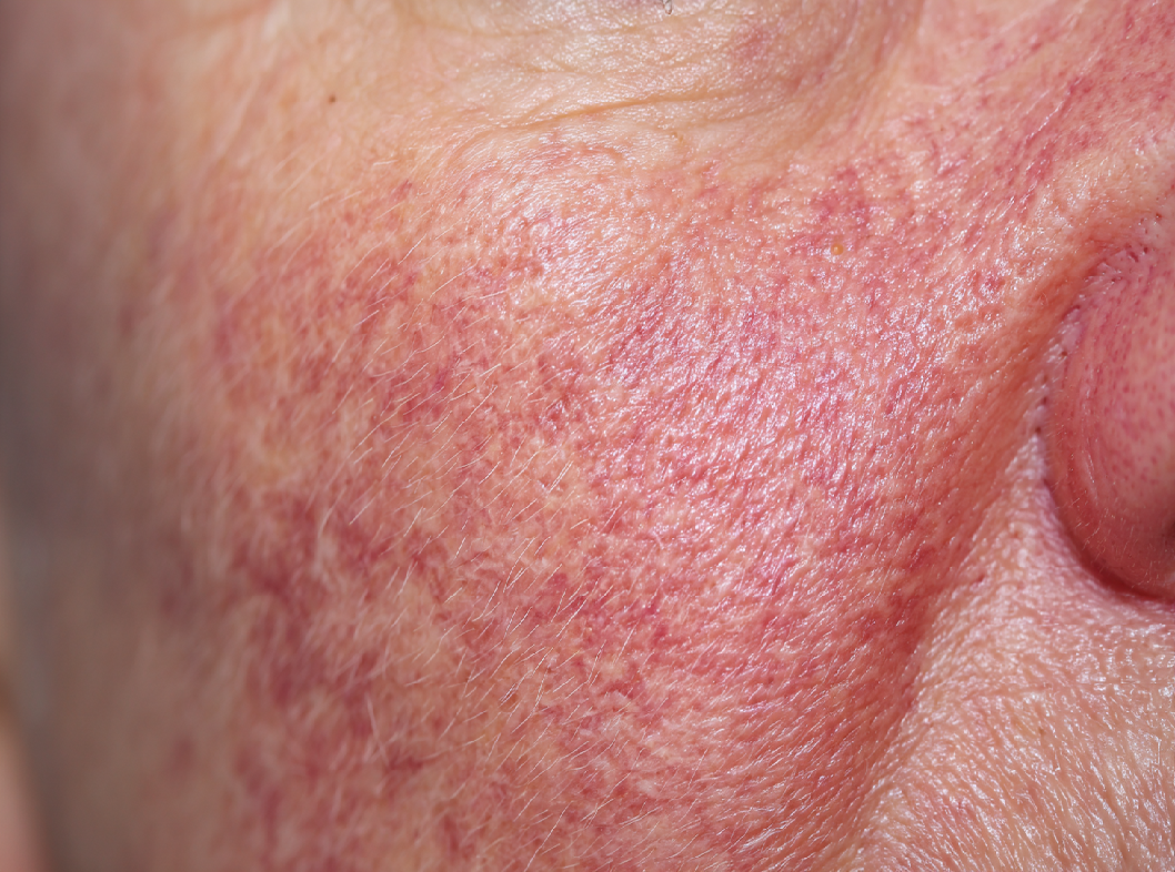 Телеангиэктазия