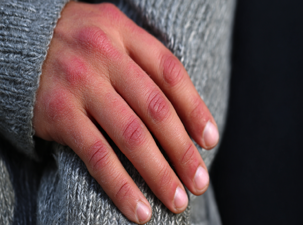 Синдром Рейно