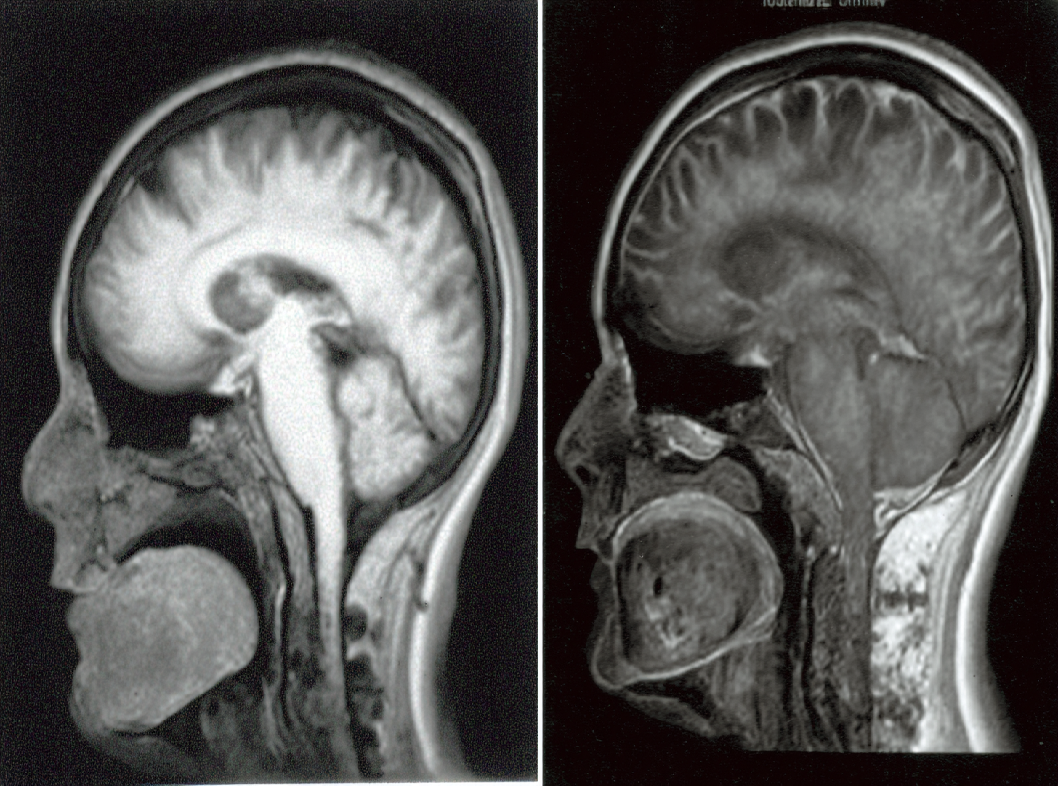 Болезнь Иценко-Кушинга
