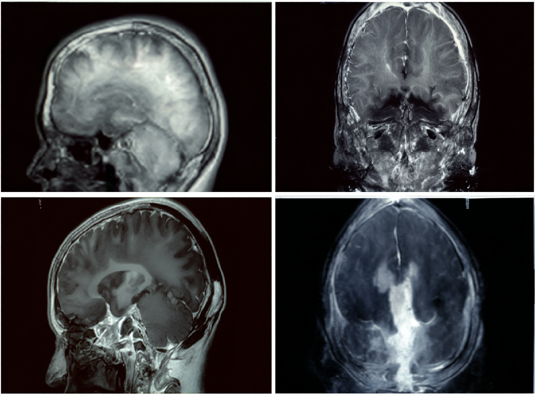 Болезнь Иценко-Кушинга