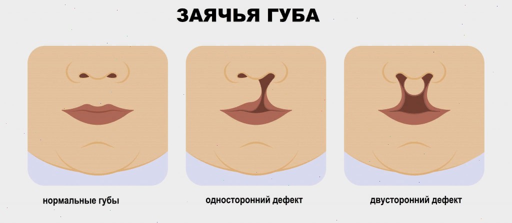 Заячья губа