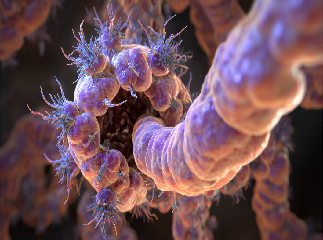 Полип толстой кишки