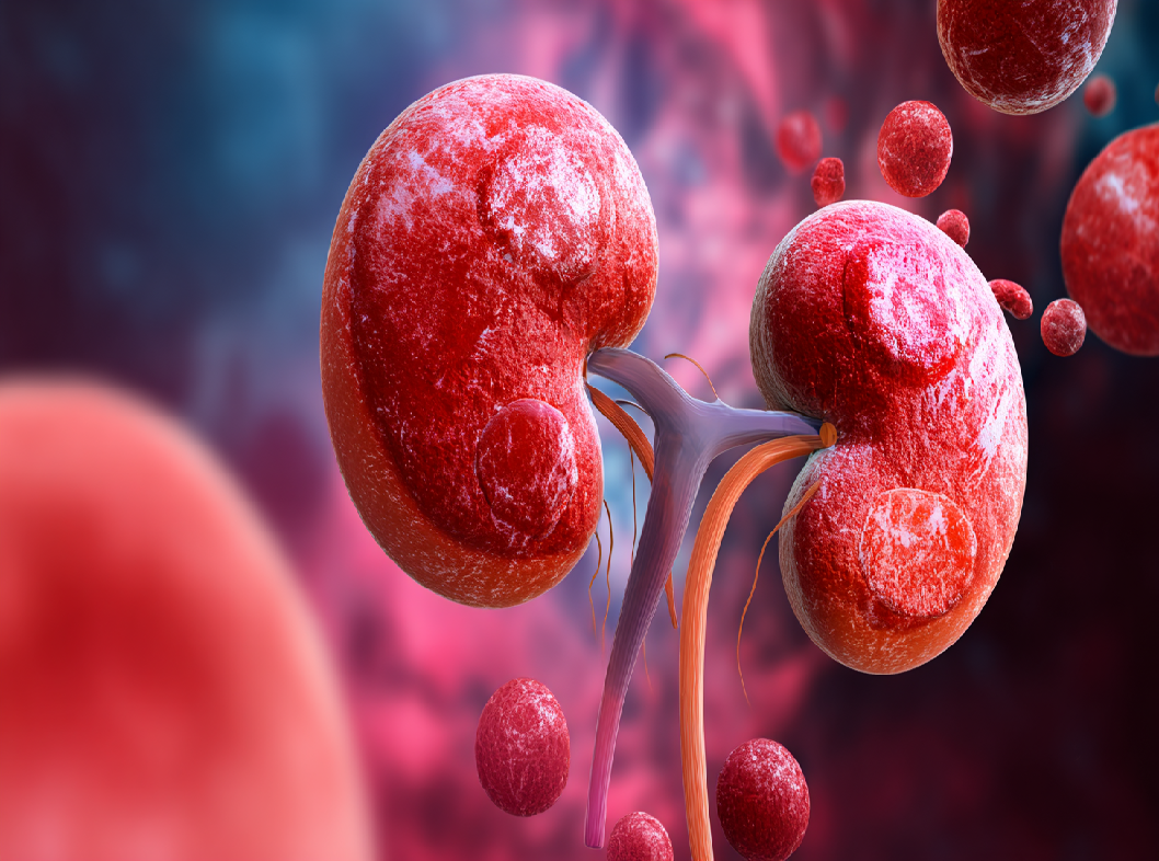 Опухоль почки