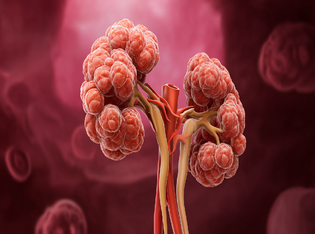 Опухоль почки