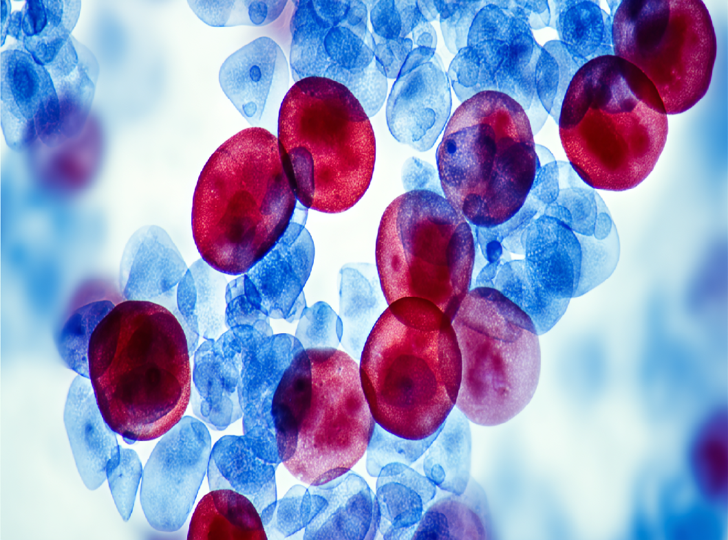 Синдром барабанных палочек