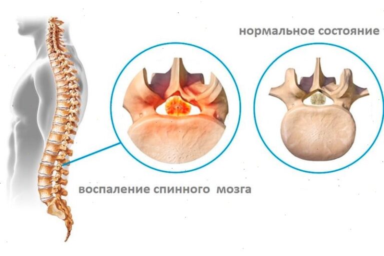 Миелит Arimed