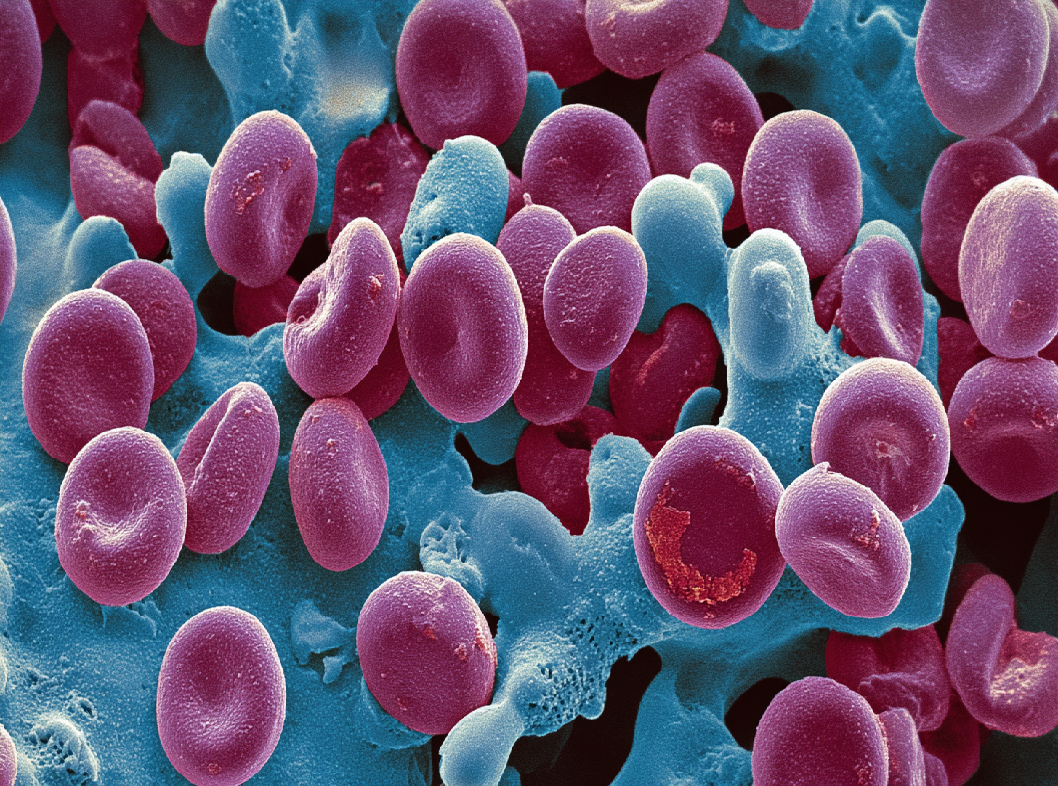 Волчаночный антикоагулянт