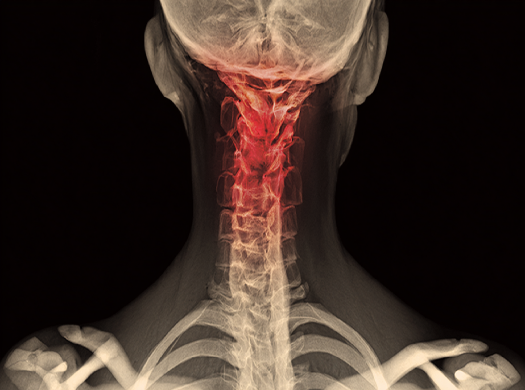 Гемангиомы в позвоночнике