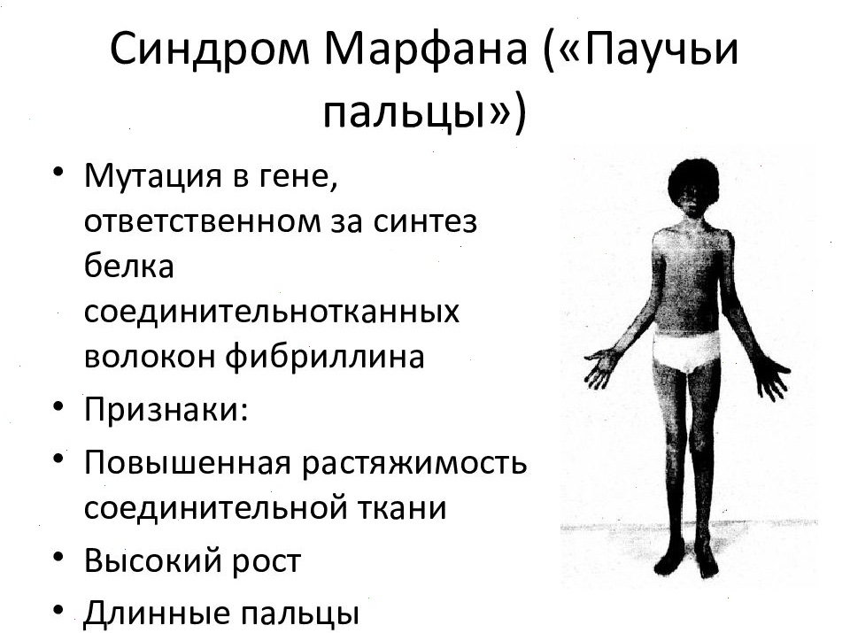 Синдром Марфана - Arimed