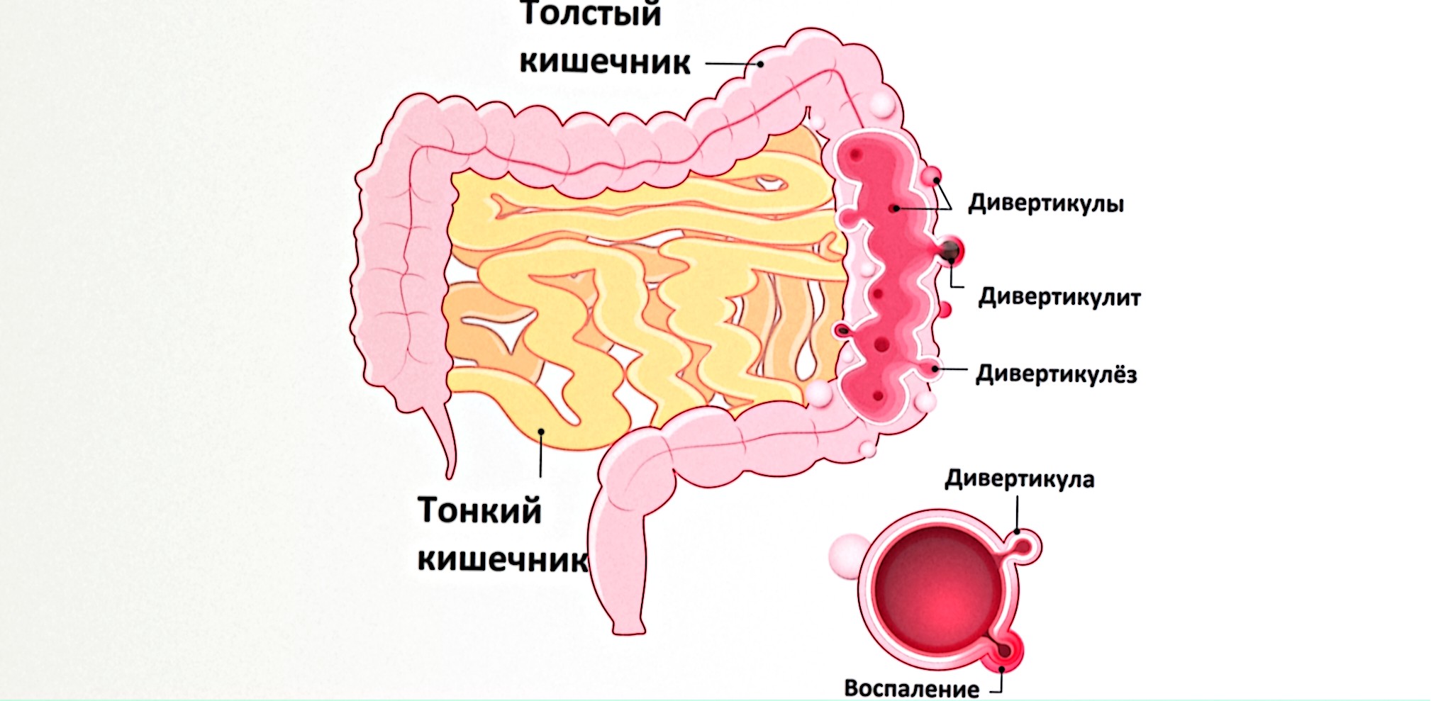 Дивертикулярная болезнь толстой кишки (ДБТК)