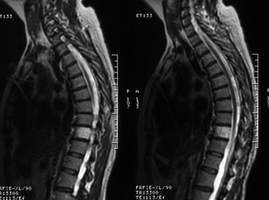 Гемангиомы в позвоночнике на мрт