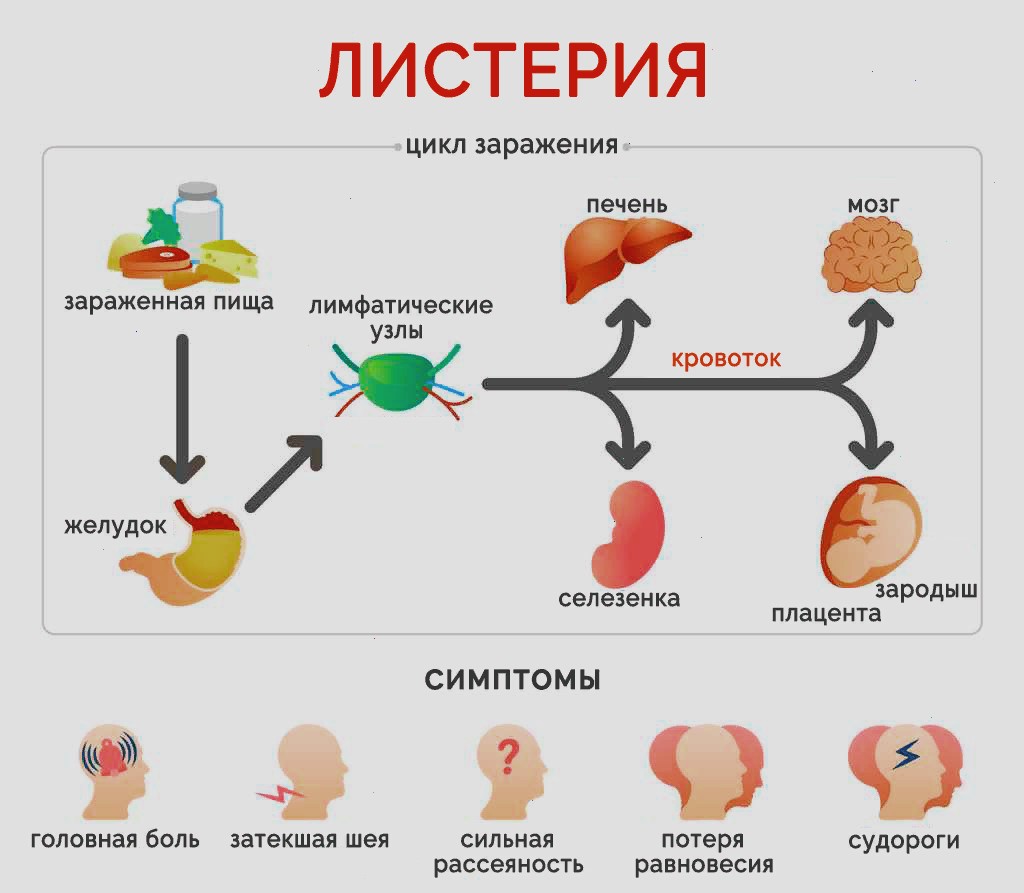 Листериоз