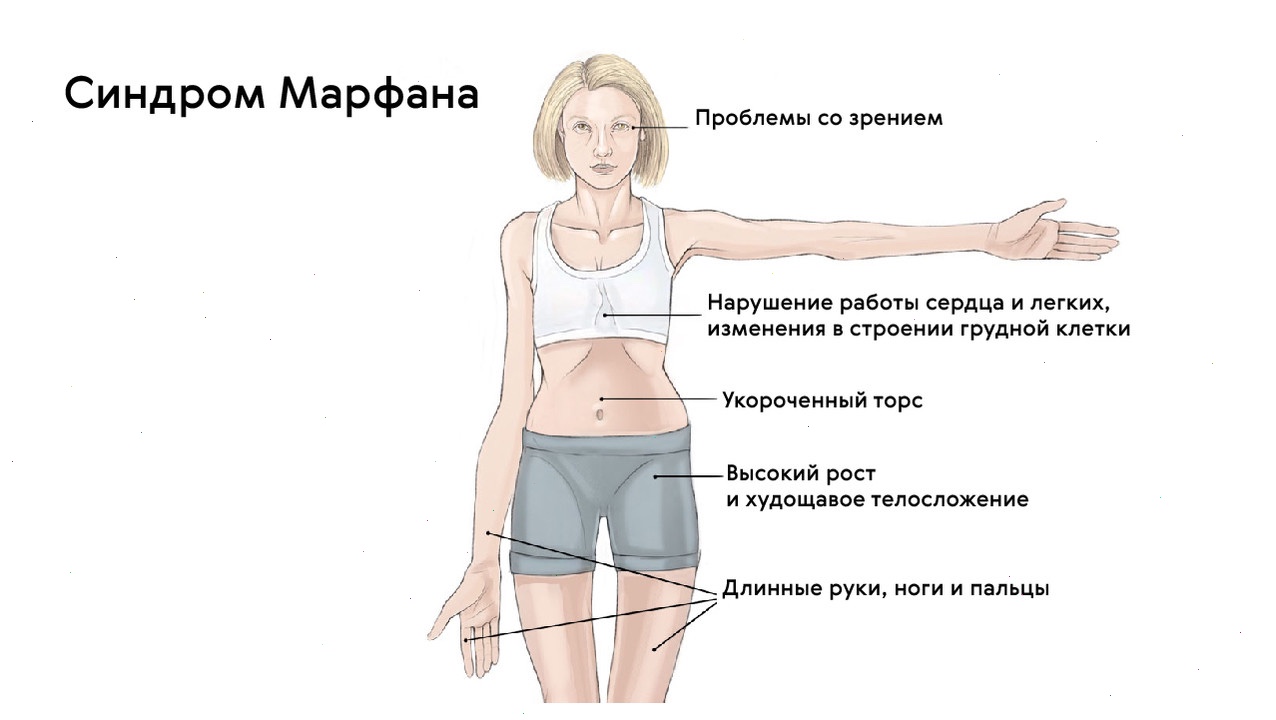 Синдром Марфана - Arimed