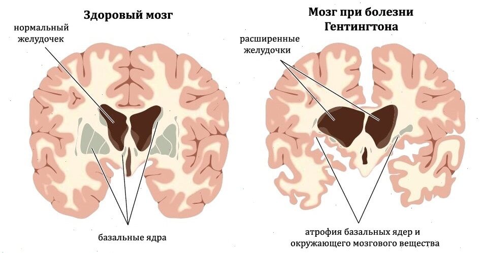 Хорея Гентингтона