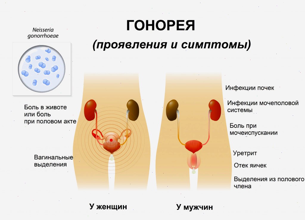 Гонорея у мужчин