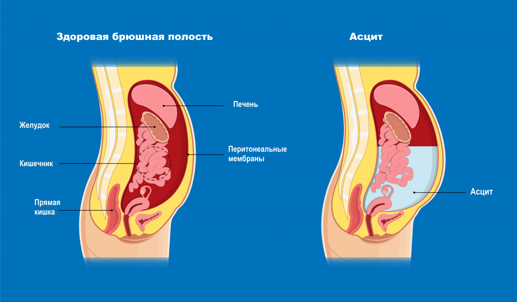 Полость причина