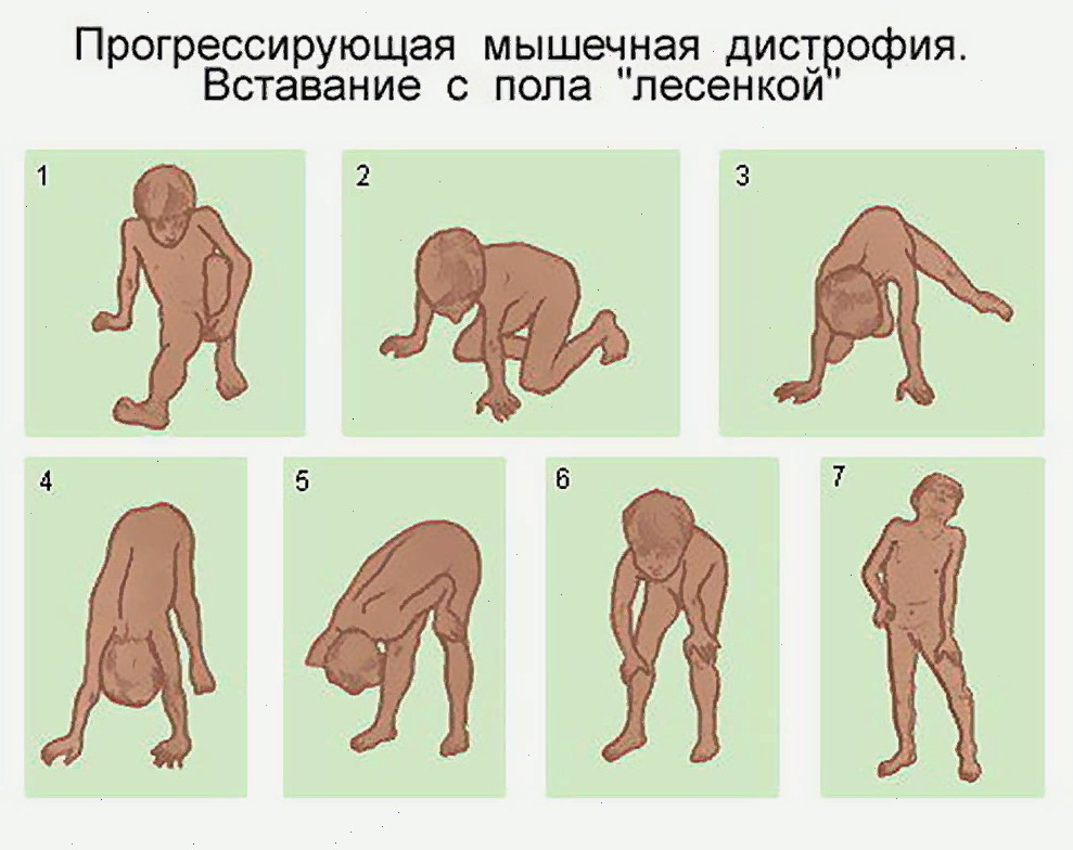 Миопатия