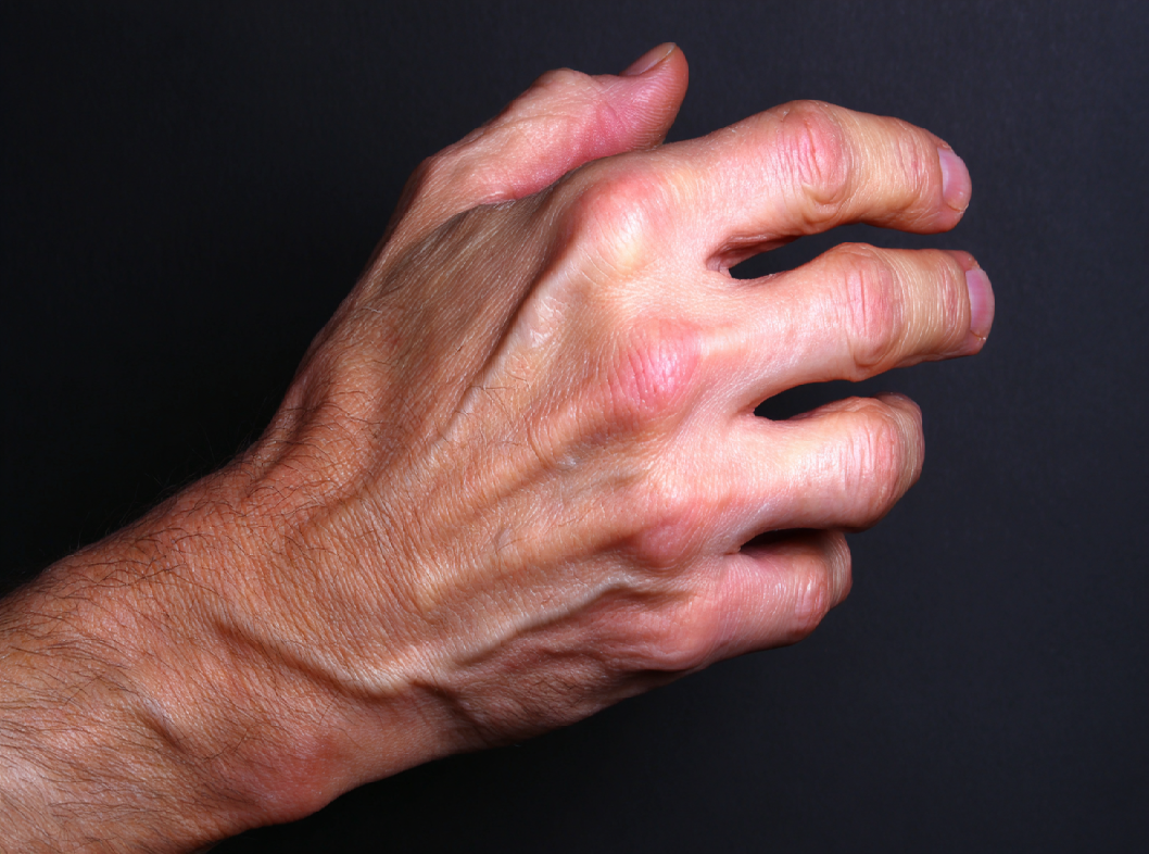 Контрактура Дюпюитрена