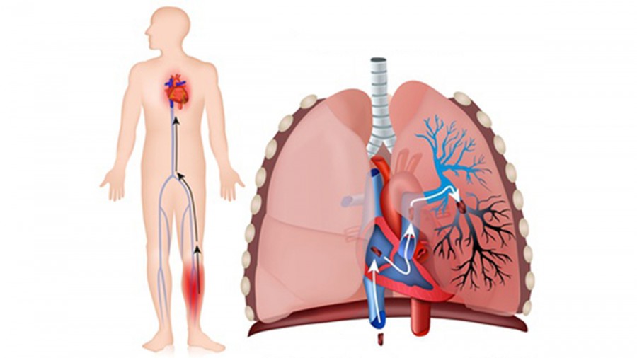 Тромбоэмболия легочных артерий