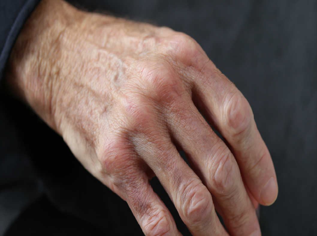 Контрактура Дюпюитрена