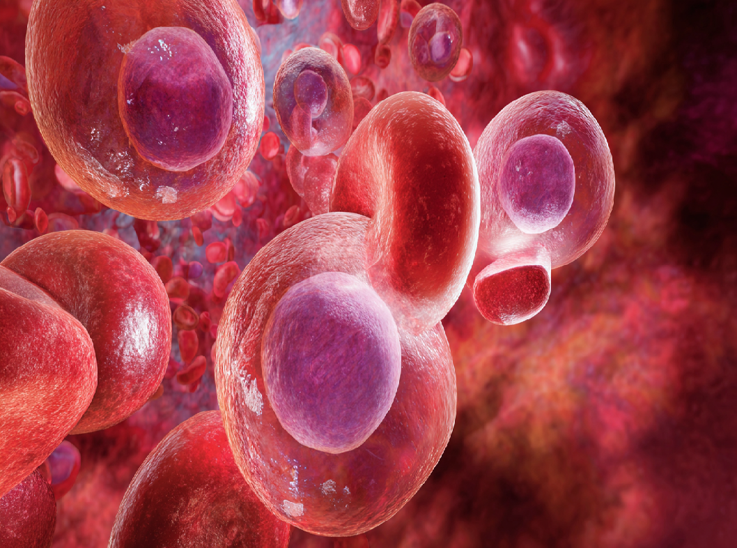 Идиопатическая возвратная гематурия