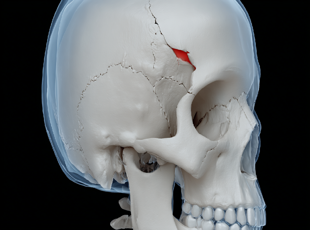 Перелом теменной кости