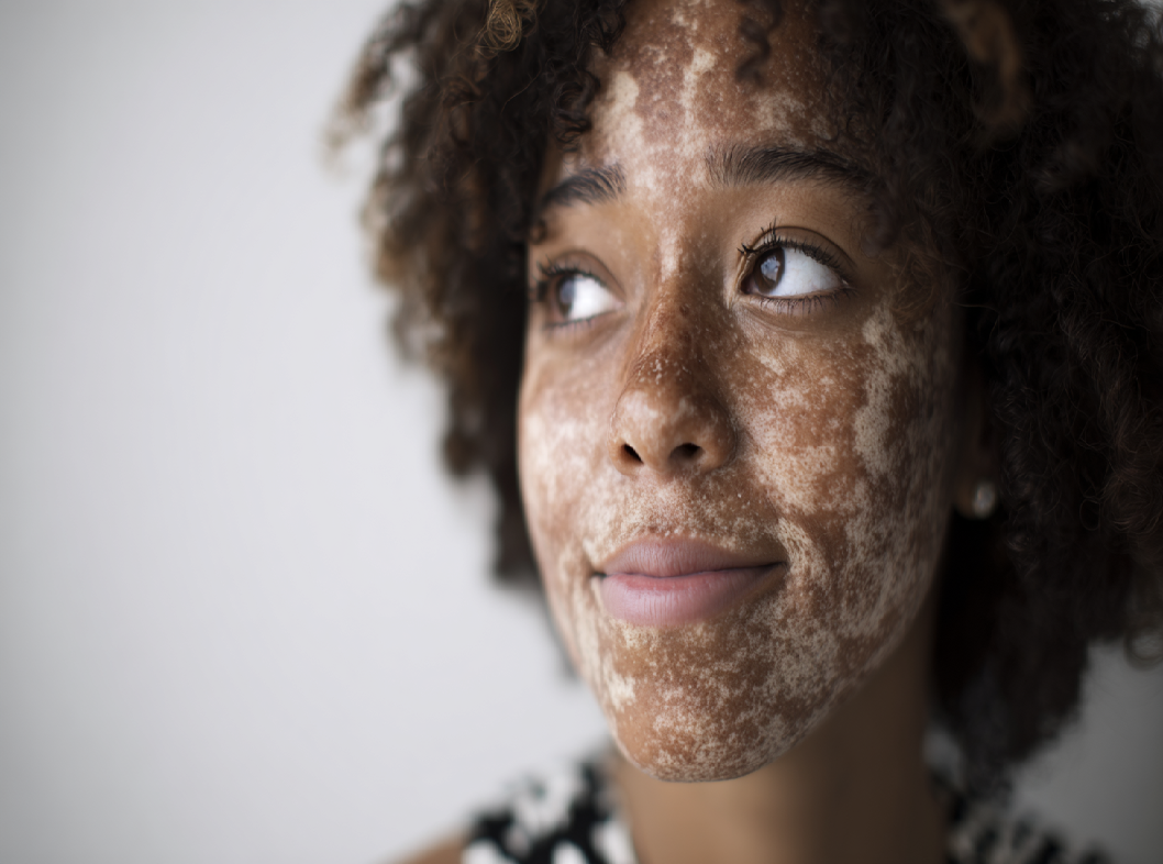 Генетическая предрасположенность к витилиго